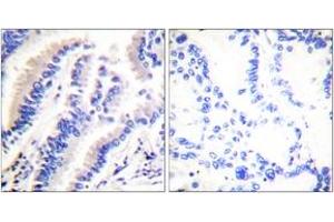 Immunohistochemistry analysis of paraffin-embedded human lung carcinoma tissue, using FADD (Ab-194) Antibody. (FADD antibody  (AA 159-208))