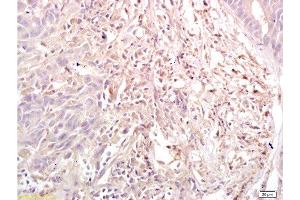 Formalin-fixed and paraffin embedded human gastric carcinoma labeled with Anti-Dnmt3a Polyclonal Antibody, Unconjugated  at 1:200, followed by conjugation to the secondary antibody and DAB staining (DNMT3A antibody  (AA 26-100))