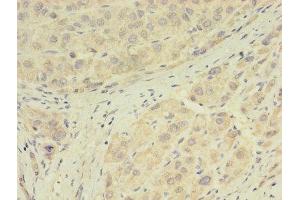 Immunohistochemistry of paraffin-embedded human liver cancer using ABIN7154076 at dilution of 1:100 (Glutathione Peroxidase 7 antibody  (AA 28-187))