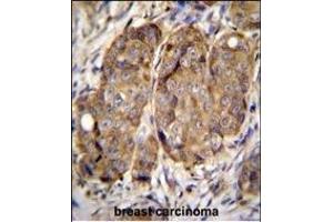 METTL2 Antibody (C-term) (ABIN655892 and ABIN2845293) immunohistochemistry analysis in formalin fixed and paraffin embedded human breast carcinoma followed by peroxidase conjugation of the secondary antibody and DAB staining. (METTL2 antibody  (C-Term))