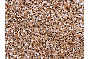 The image on the left is immunohistochemistry of paraffin-embedded Human prostate cancer tissue using ABIN7129718(HMGN5 Antibody) at dilution 1/20, on the right is treated with fusion protein. (HMGN5 antibody)
