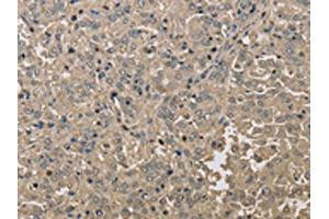 The image on the left is immunohistochemistry of paraffin-embedded Human liver cancer tissue using ABIN7191208(KDM5B Antibody) at dilution 1/40, on the right is treated with synthetic peptide. (KDM5B antibody)