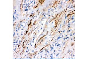 Anti- FAS Picoband antibody, IHC(P) IHC(P): Human Lung Cancer Tissue (FAS antibody  (AA 26-173))
