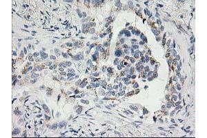 Immunohistochemical staining of paraffin-embedded Carcinoma of Human lung tissue using anti-SNAP25 mouse monoclonal antibody. (SNAP25 antibody)