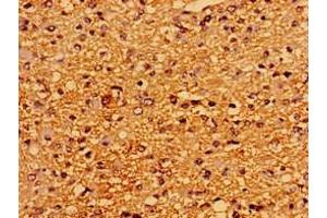 Immunohistochemistry of paraffin-embedded human glioma using ABIN7167523 at dilution of 1:100 (PTPRZ1 antibody  (AA 36-300))