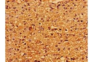 Immunohistochemistry of paraffin-embedded human glioma using ABIN7167523 at dilution of 1:100
