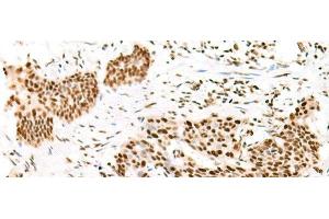 Immunohistochemistry of paraffin-embedded Human esophagus cancer tissue using TCOF1 Polyclonal Antibody at dilution of 1:50(x200) (TCOF1 antibody)