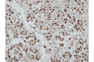 IHC-P Image Immunohistochemical analysis of paraffin-embedded human ovarian cancer, using SEPHS2, antibody at 1:100 dilution. (SEPHS2 antibody)