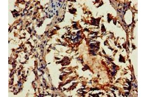 Immunohistochemistry of paraffin-embedded human lung tissue using ABIN7154436 at dilution of 1:100 (GAB2 antibody  (AA 273-484))
