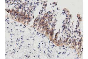 Immunohistochemical staining of paraffin-embedded Carcinoma of Human thyroid tissue using anti-PECR mouse monoclonal antibody.
