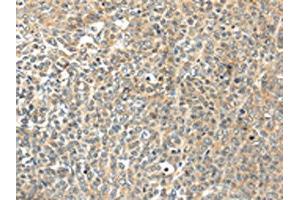 The image on the left is immunohistochemistry of paraffin-embedded Human ovarian cancer tissue using ABIN7192947(TSPYL6 Antibody) at dilution 1/20, on the right is treated with synthetic peptide. (TSPY-Like 6 antibody)