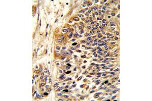 Formalin-fixed and paraffin-embedded human bladder carcinoma reacted with WNT4 Antibody (Center), which was peroxidase-conjugated to the secondary antibody, followed by DAB staining. (WNT4 antibody  (AA 211-239))