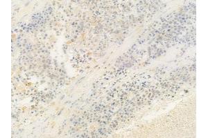ABIN6263052 and ABIN6278809 at 1/100 staining human prostate carcinoma by IHC-P.