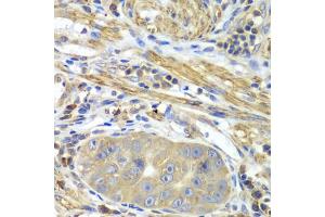 Immunohistochemistry of paraffin-embedded human gastric cancer using PICK1 antibody.