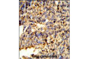 Formalin-fixed and paraffin-embedded human lung carcinoma reacted with FCGR2C Antibody , which was peroxidase-conjugated to the secondary antibody, followed by DAB staining.