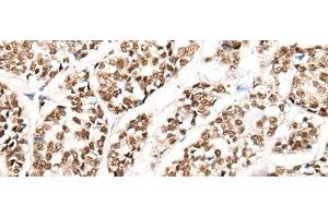 Immunohistochemistry of paraffin-embedded Human esophagus cancer tissue using HGH1 Polyclonal Antibody at dilution of 1:45(x200) (FAM203B antibody)