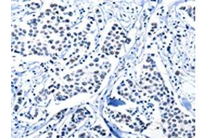 The image on the left is immunohistochemistry of paraffin-embedded Human breast cancer tissue using ABIN7191961(POU2AF1 Antibody) at dilution 1/15, on the right is treated with synthetic peptide. (POU2AF1 antibody)