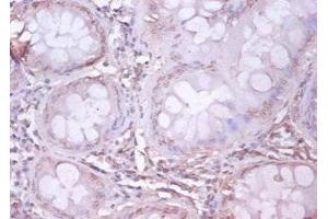 Immunohistochemistry of paraffin-embedded human colon cancer using ABIN7144046 at dilution of 1:100 (APP antibody  (AA 18-664))