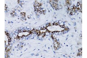 Immunohistochemistry of paraffin-embedded human breast cancer using BRCA1 antibody. (BRCA1 antibody  (AA 120-220))