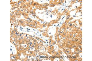 Immunohistochemistry of Human lung cancer using TRAF3 Polyclonal Antibody at dilution of 1:40 (TRAF3 antibody)