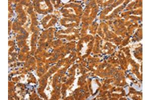 The image on the left is immunohistochemistry of paraffin-embedded Human thyroid cancer tissue using ABIN7192830(TNFRSF8 Antibody) at dilution 1/60, on the right is treated with synthetic peptide. (TNFRSF8 antibody)
