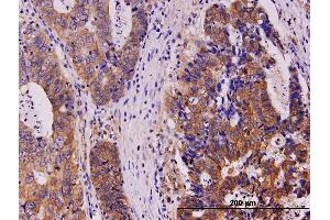 Immunoperoxidase of monoclonal antibody to KIT on formalin-fixed paraffin-embedded human stomach carcinoma. (KIT antibody  (AA 41-140))