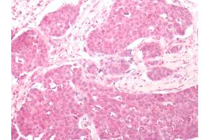 Human Breast Carcinoma: Formalin-Fixed, Paraffin-Embedded (FFPE) (FZD2 antibody  (N-Term))