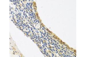 Immunohistochemistry of paraffin-embedded Human lung cancer using Endothelin 1 Polyclonal Antibody at dilution of 1:100 (40x lens). (Endothelin 1 antibody)