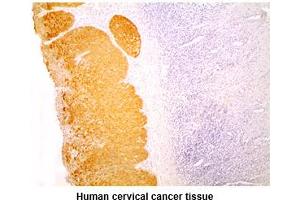 Paraffin embedded sections of human cervical cancer tissue were incubated with anti-human KRT14 (1:200) for 2 hours at room temperature.