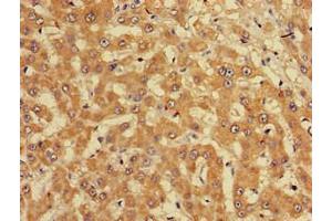 Immunohistochemistry of paraffin-embedded human liver cancer using ABIN7165226 at dilution of 1:100 (CUTA antibody  (AA 33-150))