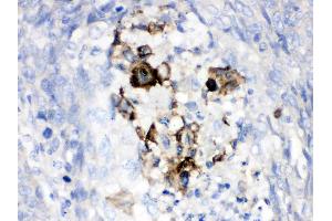 Factor B was detected in paraffin-embedded sections of human lung cancer tissues using rabbit anti- Factor B Antigen Affinity purified polyclonal antibody (Catalog # ) at 1 ? (Complement Factor B antibody  (AA 518-764))