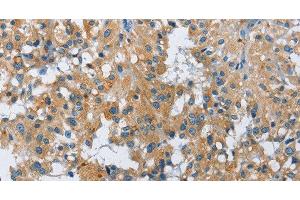 Immunohistochemistry of paraffin-embedded Human thyroid cancer using FGF9 Polyclonal Antibody at dilution of 1:40 (FGF9 antibody)
