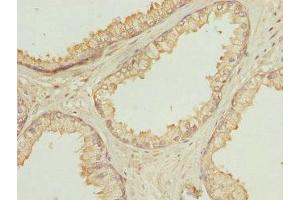 Immunohistochemistry of paraffin-embedded human prostate cancer using ABIN7162292 at dilution of 1:100