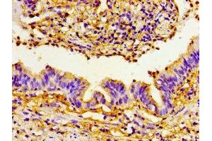 Immunohistochemistry of paraffin-embedded human lung cancer using ABIN7160458 at dilution of 1:100 (PRTN3 antibody  (AA 1-170))
