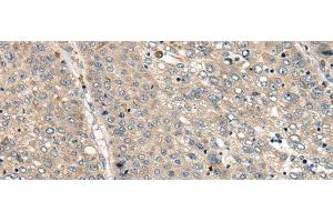 Immunohistochemistry of paraffin-embedded Human liver cancer tissue using CC2D1A Polyclonal Antibody at dilution of 1:35(x200) (CC2D1A antibody)