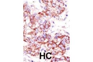 Formalin-fixed and paraffin-embedded human cancer tissue reacted with the primary antibody, which was peroxidase-conjugated to the secondary antibody, followed by AEC staining. (USP4 antibody  (C-Term))