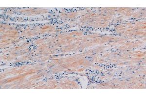 Detection of CTXI in Human Prostate Tissue using Polyclonal Antibody to Cross Linked C-Telopeptide Of Type I Collagen (CTXI) (CTX-I antibody)