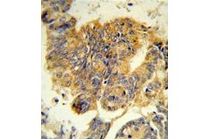 Formalin-fixed, paraffin-embedded human colon carcinoma reacted with CD114 / CSF3R Antibody (Center) Cat. (CSF3R antibody  (Middle Region))