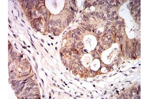 Immunohistochemical analysis of paraffin-embedded colon cancer tissues using CPV-VP2 mouse mAb with DAB staining. (CPV-VP2 (AA 1-128) antibody)