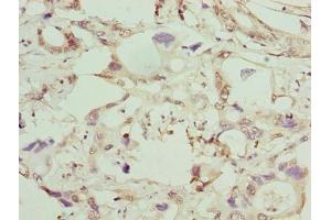 Immunohistochemistry of paraffin-embedded human pancreatic cancer using ABIN7154064 at dilution of 1:100 (GGTLC1 antibody  (AA 1-225))