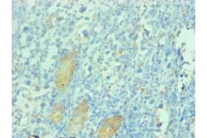 Immunohistochemical of paraffin-embedded human gastric cancer tissue using ABIN7163025 at dilution of 1:200 (PGC antibody)