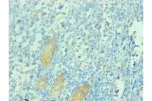 Immunohistochemical of paraffin-embedded human gastric cancer tissue using ABIN7163025 at dilution of 1:200 (PGC antibody)