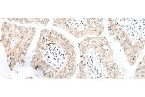 Immunohistochemistry of paraffin-embedded Human liver cancer tissue using NGEF Polyclonal Antibody at dilution of 1:35(x200) (NGEF antibody)