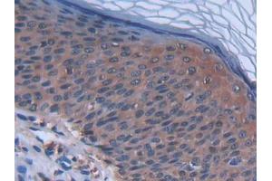DAB staining on IHC-P; Samples: Human Skin cancer Tissue (CCL27 antibody  (AA 25-112))