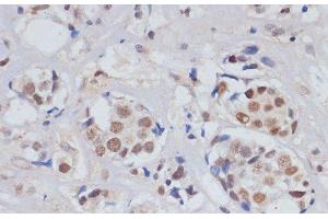 Immunohistochemistry of paraffin-embedded Human breast cancer using SKIV2L2 Polyclonal Antibody at dilution of 1:100 (40x lens). (MTR4 antibody)