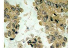 Immunohistochemistry analysis of Akt2 antibody in paraffin-embedded human lung carcinoma tissue. (AKT2 antibody)