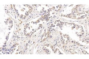 Detection of RRM1 in Human Lung cancer Tissue using Polyclonal Antibody to Ribonucleotide Reductase M1 (RRM1) (RRM1 antibody  (AA 1-213))