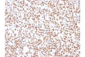 IHC testing of FFPE human thyroid carcinoma with PAX8 antibody (clone PAX8/1492). (PAX8 antibody  (AA 60-261))