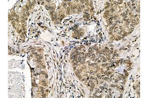 ABIN7095525 and ABIN7099582 at 1/100 staining human lung cancer and adjacent non-tumor tissue by IHC-P. (WDR77 antibody)