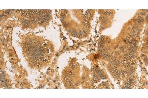 Immunohistochemistry of paraffin-embedded Human colon cancer tissue using RPL26L1 Polyclonal Antibody at dilution 1:30 (RPL26L1 antibody)